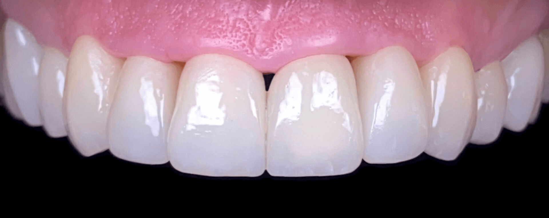 despues-1-1-dental-esthetic